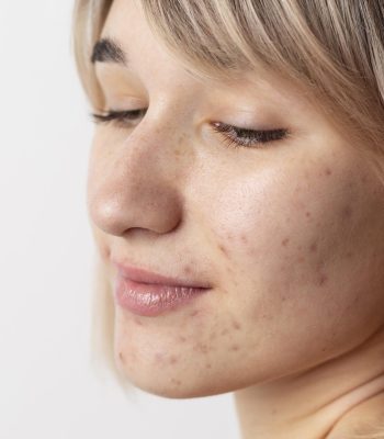 close-up-woman-with-acne-posing
