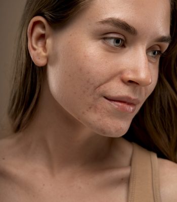 portrait-person-with-dermatitis-skin-condition